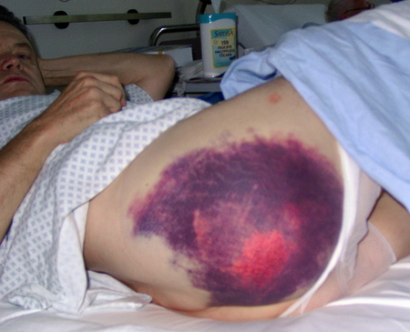 Ausgedehntes Hämatom der rechten Hüft- und Gesäßregion
