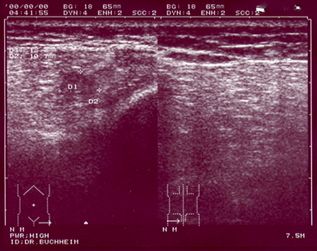 Sonographischer Befund des Hämatoms